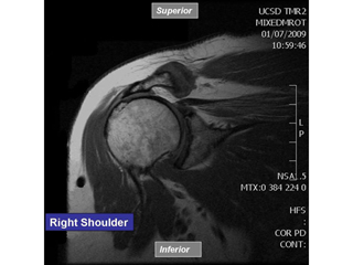 Rotator Cuff Tear, Right Shoulder, MRI