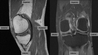 Medial Meniscal Tear, Left Knee, MRI