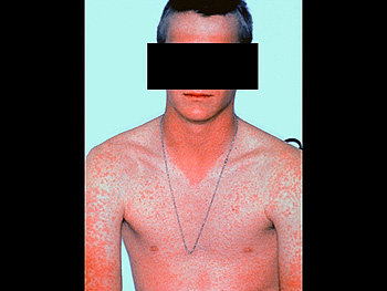 Ampicillin drug rash, clinical photo