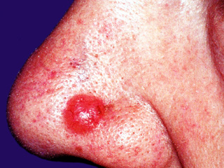 Basal cell carcinoma, clinical photo