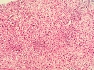 Acute viral hepatitis B, H & E stain