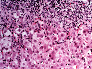 Chronic hepatitis, H & E stain