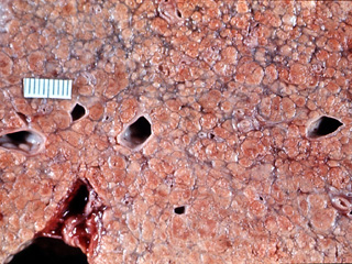 Chronic hepatitis, gross and H & E stain