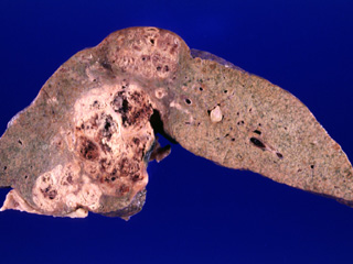 Hepatocellular carcinoma, gross