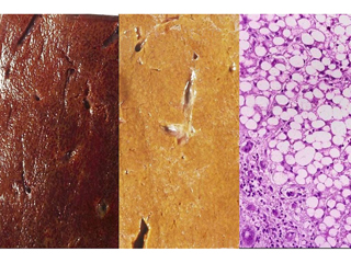 Liver, steatosis (fatty liver), gross and H & E stain