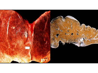 Fulminant hepatitis, gross