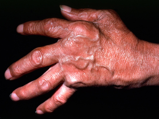 Rheumatoid arthritis, clinical photo