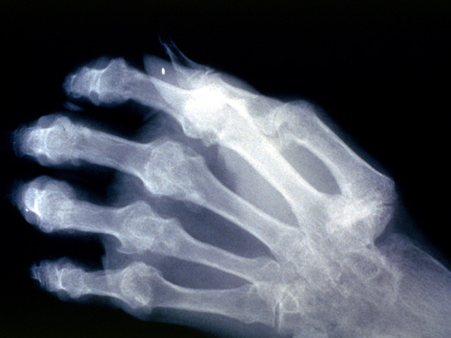 Rheumatoid arthritis, radiograph