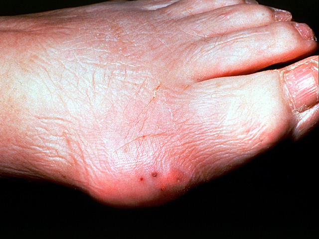 Gouty arthritis, clinical photo