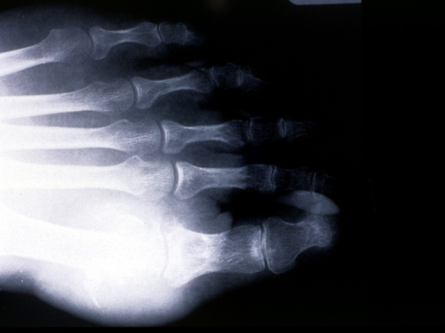 Gouty arthritis, radiograph
