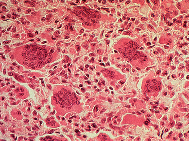 Giant cell tumor, high-power, H & E stain