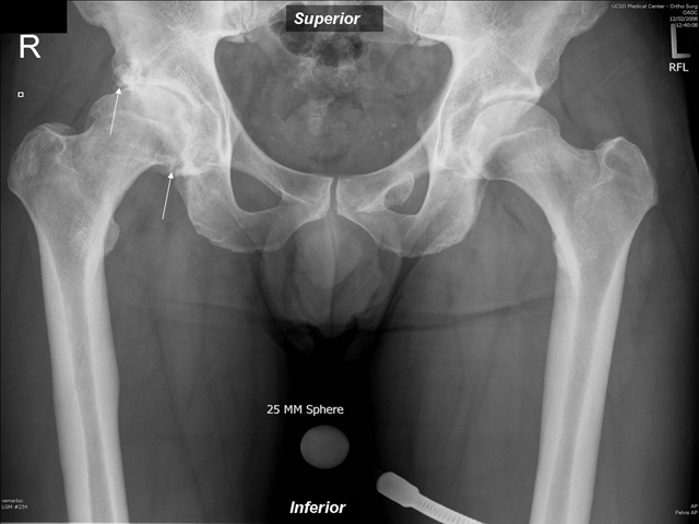 Degenerative Joint Disease, Right Hip Joint, radiograph  