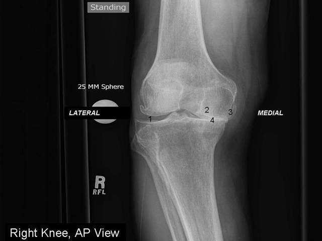 Degenerative Joint Disease (Osteoarthritis), Right Knee, radiograph
