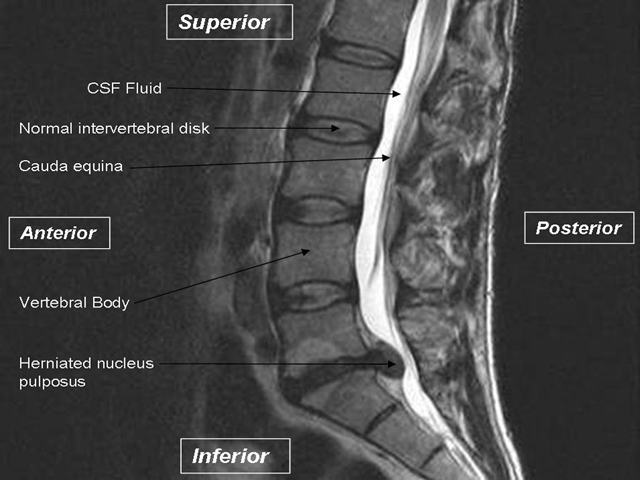 Degenerative Disk Disease, Lumbar Spine, MRI 