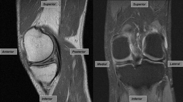 Medial Meniscal Tear, Left Knee, MRI