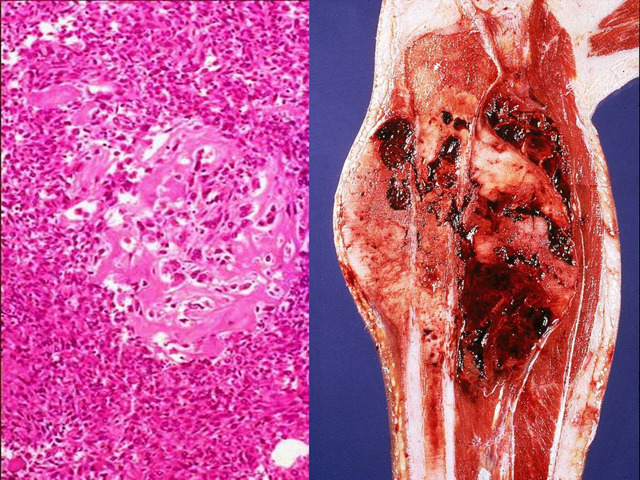 Osteosarcoma, gross and H & E stain