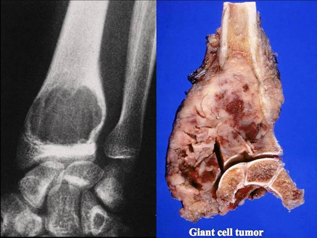 Giant Cell Tumor, radiograph and gross views