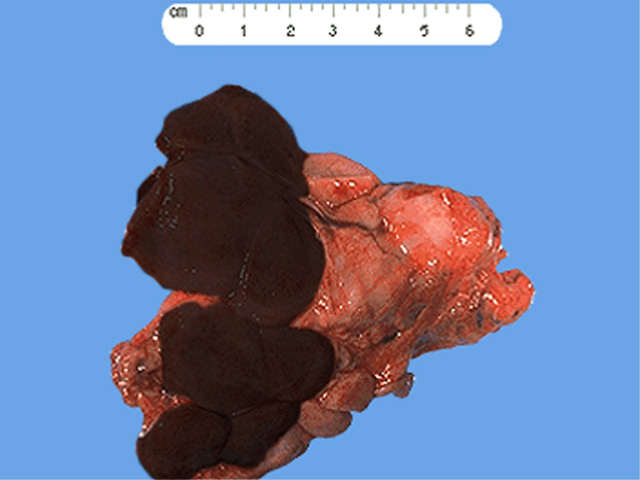 shotty lymph nodes cancer