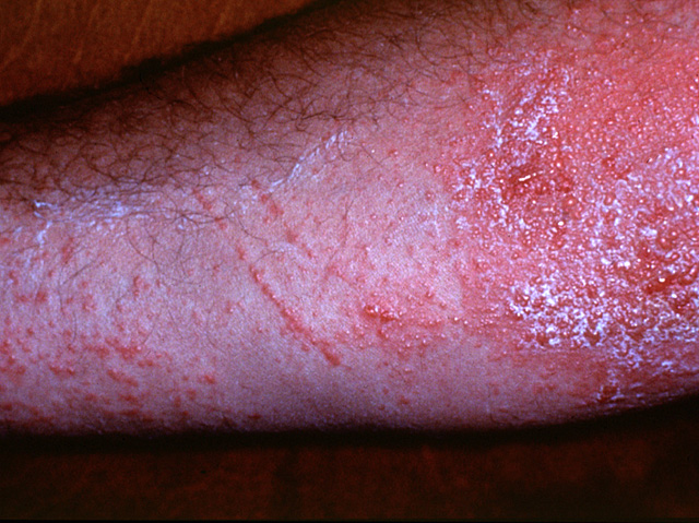 Allergic contact dermatitis, clinical photo