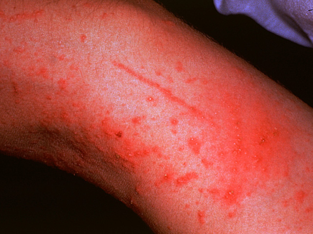 Allergic contact dermatitis, clinical photo