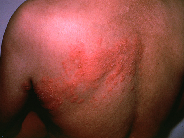 Herpes zoster, clinical photo