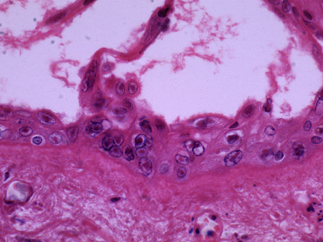 Herpes zoster, intranuclear inclusions, H & E