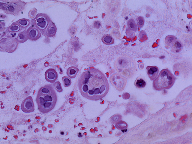 Herpes zoster, multinucleated epidermal cell