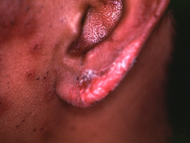Lupus erythematosus, skin lesion of the ear