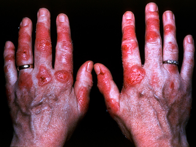 Lupus erythematosus, skin lesion of the hands