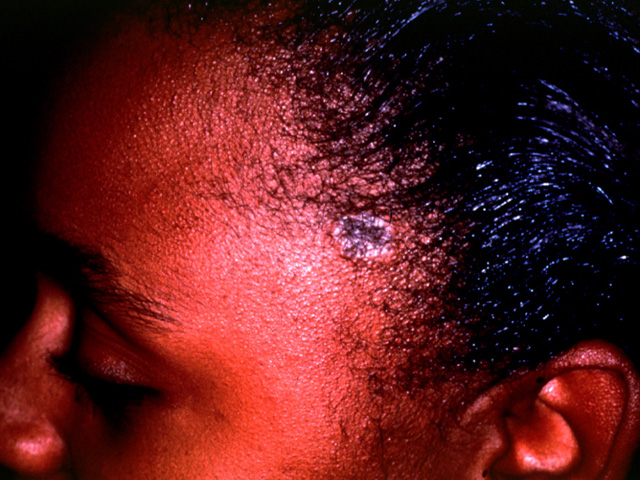 Discoid lupus erythematosus, scalp lesion