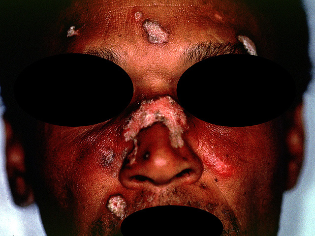 Discoid lupus erythematosus, facial lesion