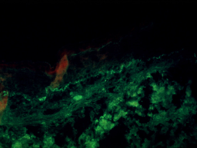 Lupus erythematosus, immunofluorescent C3