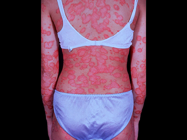 Psoriasis, clinical photo