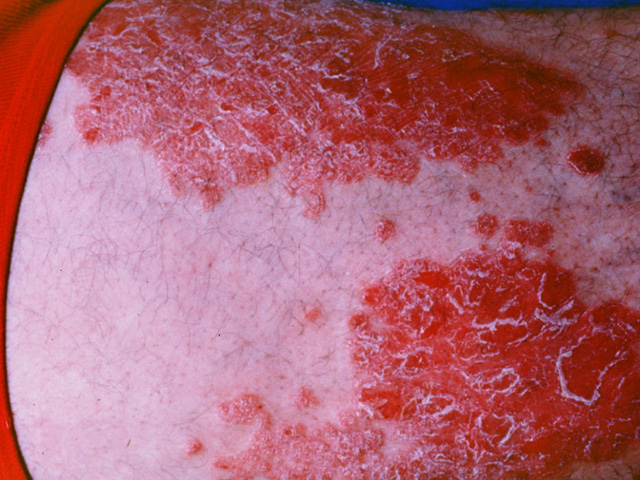 Psoriasis, clinical photo