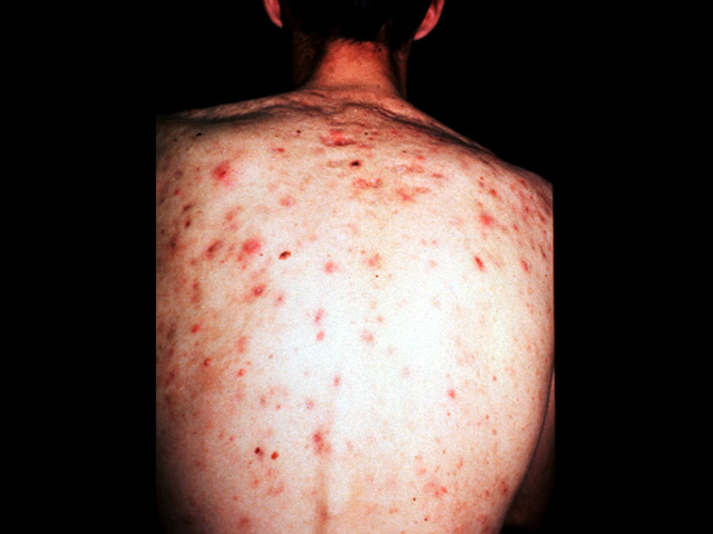 Acne, back, clinical photo