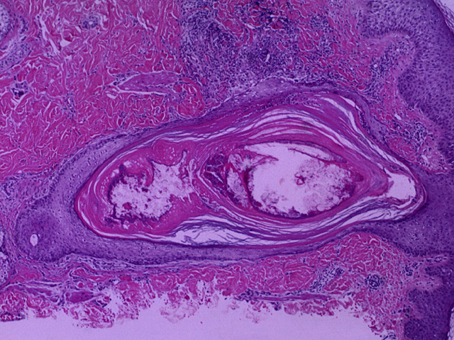 Acne, H & E stain