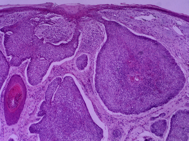 Basal cell carcinoma, H & E stain