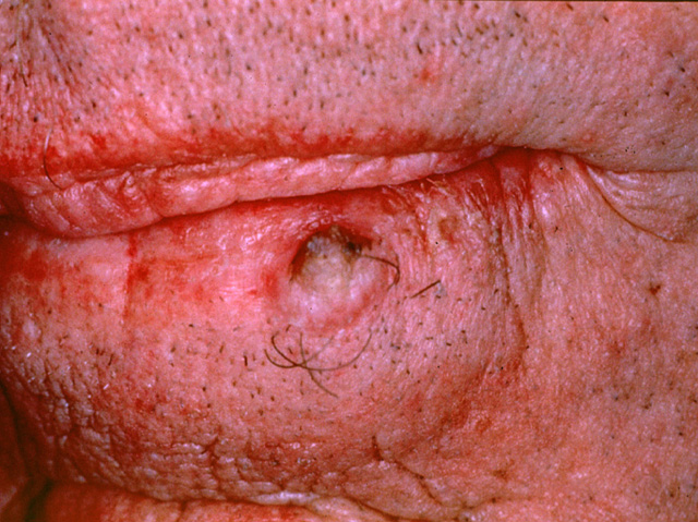 Squamous cell carcinoma, clinical photo