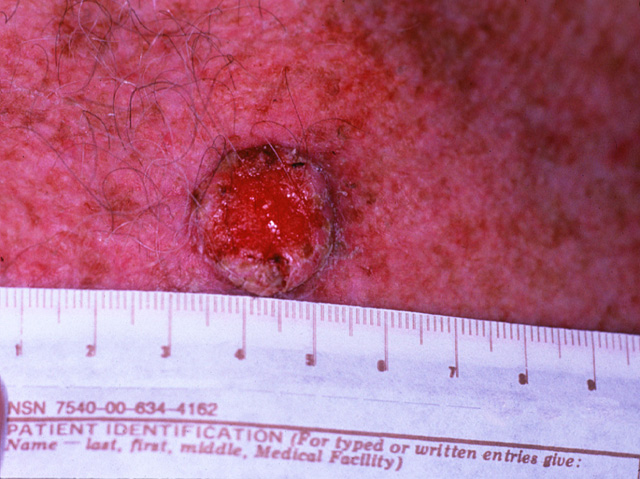 Squamous cell carcinoma, clinical photo