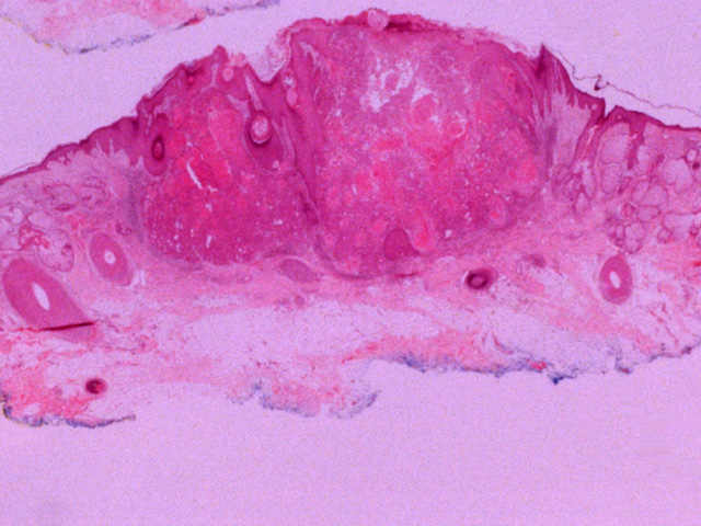 Squamous cell carcinoma, H & E stain