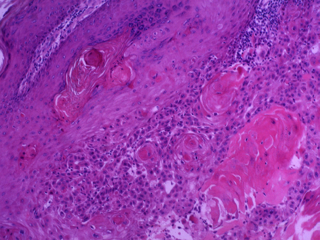 Squamous cell carcinoma, H & E stain
