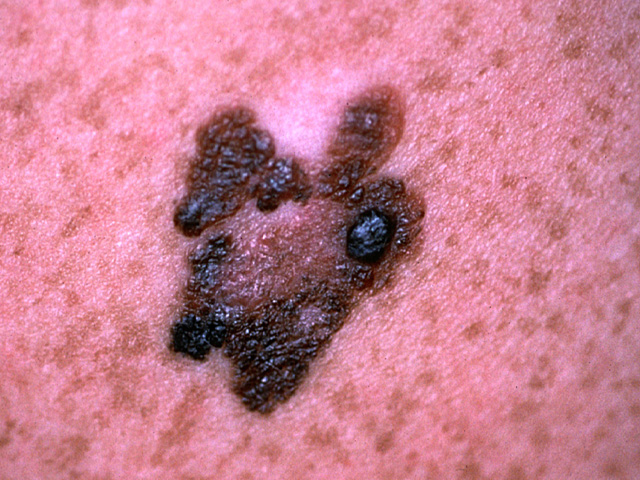 Malignant melanoma, clinical photo