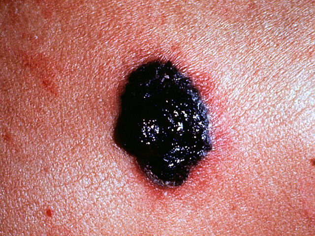 Malignant melanoma, clinical photo