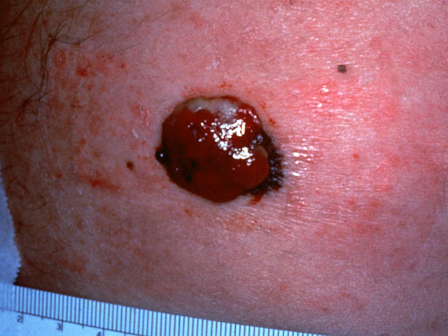 Malignant melanoma, clinical photo