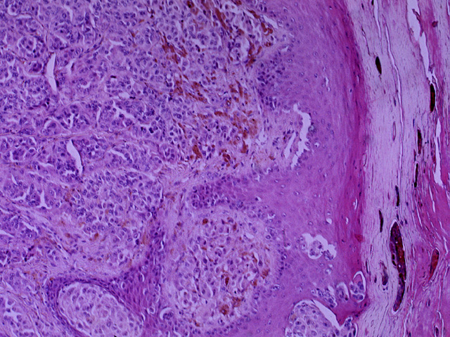 Malignant melanoma, H & E stain