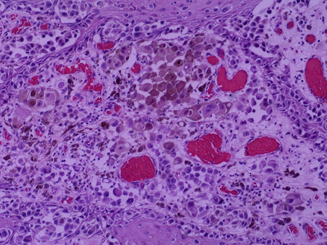 Malignant melanoma, H & E stain