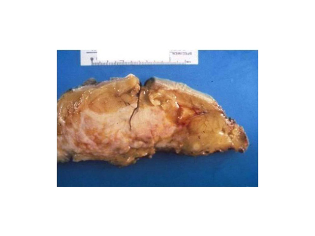invasive ductal carcinoma gross