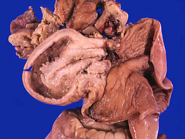 Small intestine: Crohn's disease, gross