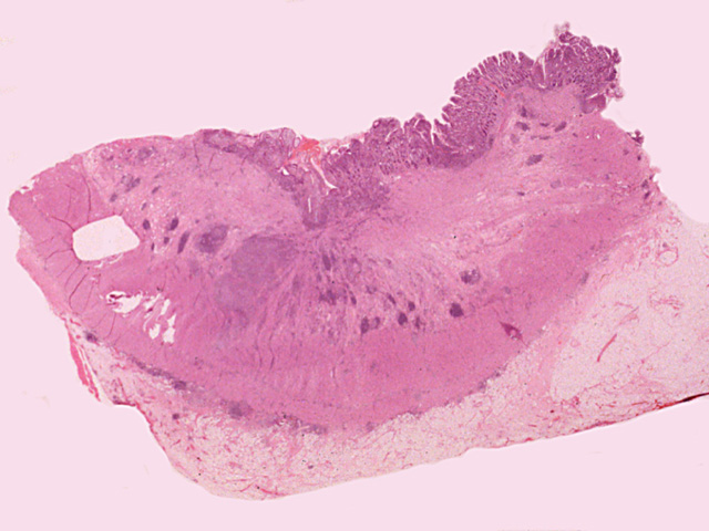 Small intestine: Crohn's disease, H & E