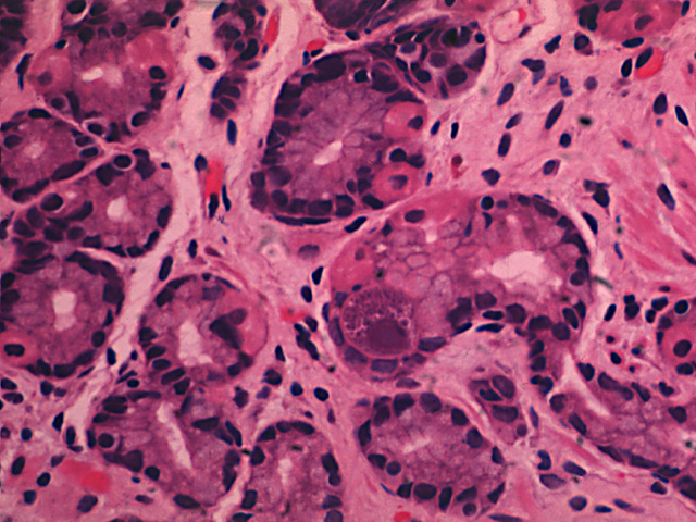 Stomach: CMV infection, H & E stain